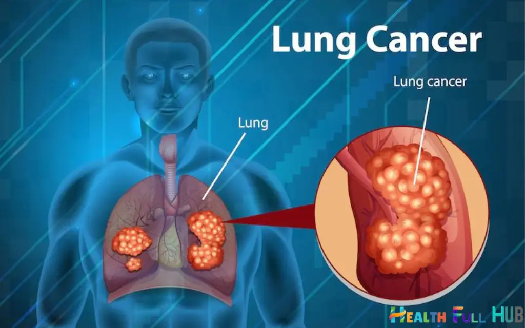 lung cancer