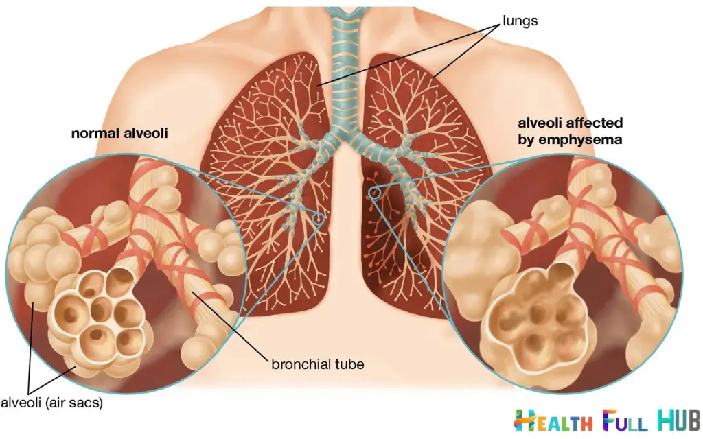 lung disease