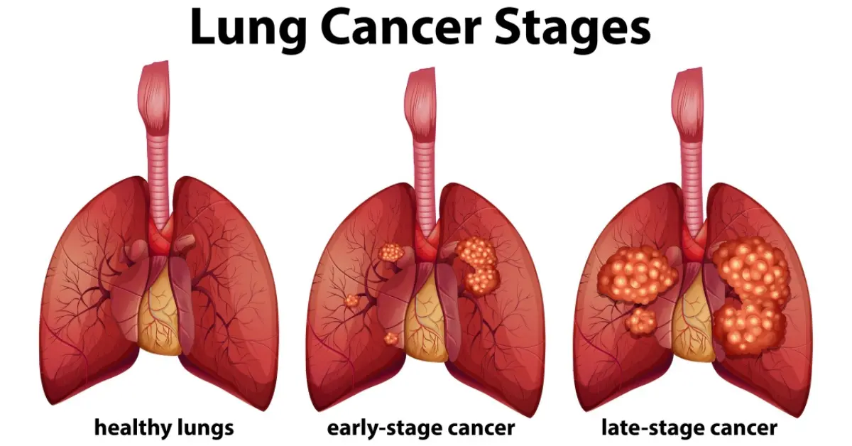 lung cancer